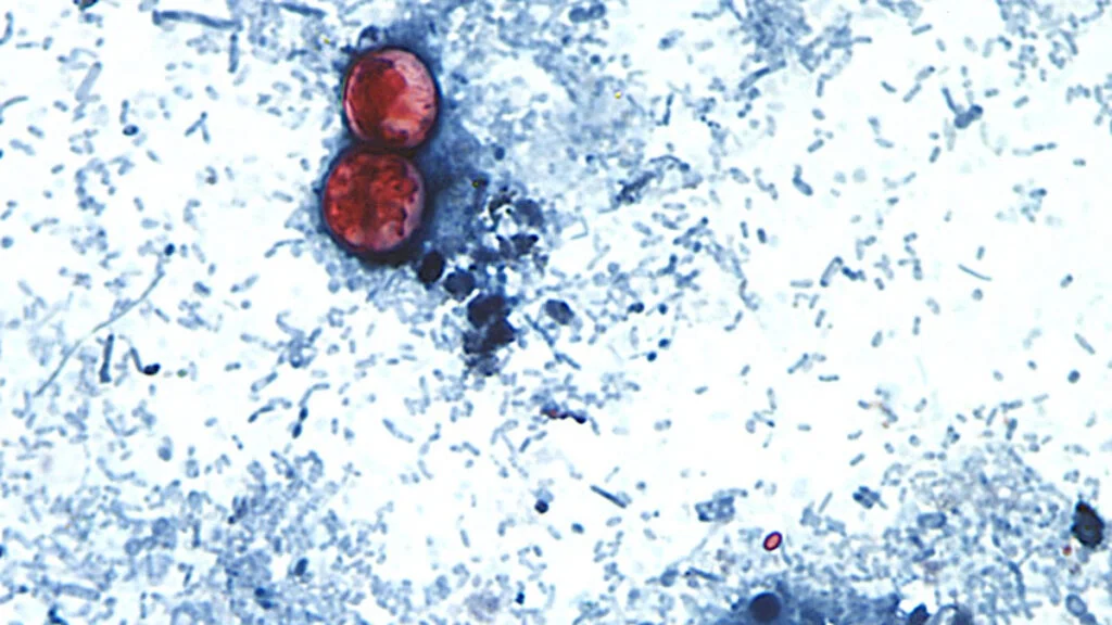 Outbreak of diarrhea-causing parasite grows to more than 1,000 cases