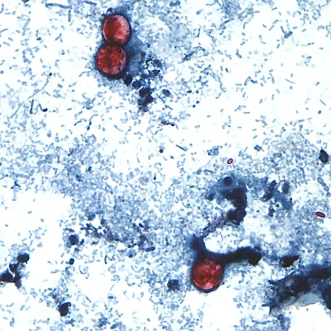 A photo taken through a microscope of Cyclospora cayetanensis oocysts found in a fresh stool sample.