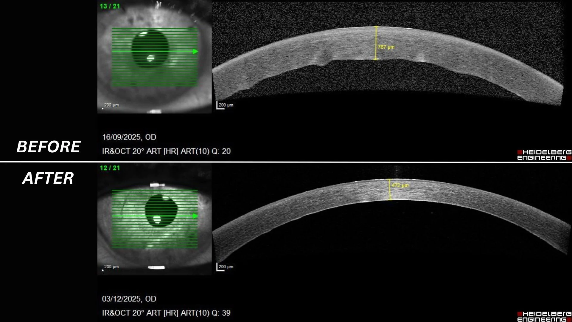 Two images show medical scans of a person's cornea, before and after a transplant procedure