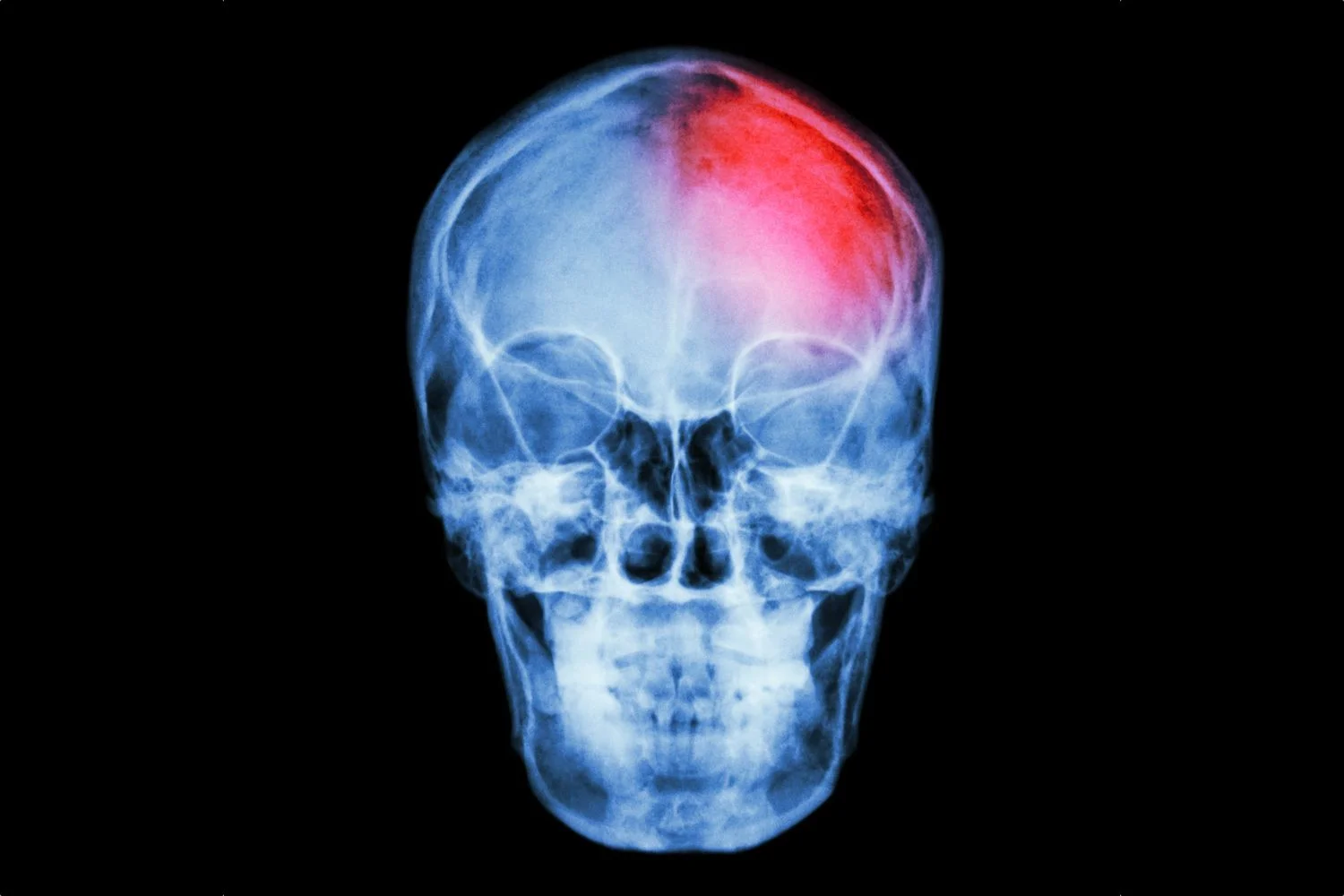 an x ray of a skull with a portion highlighted in red